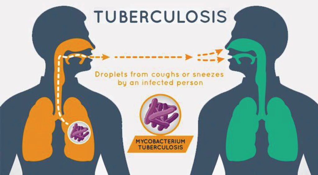 Tuberculosis (TB)