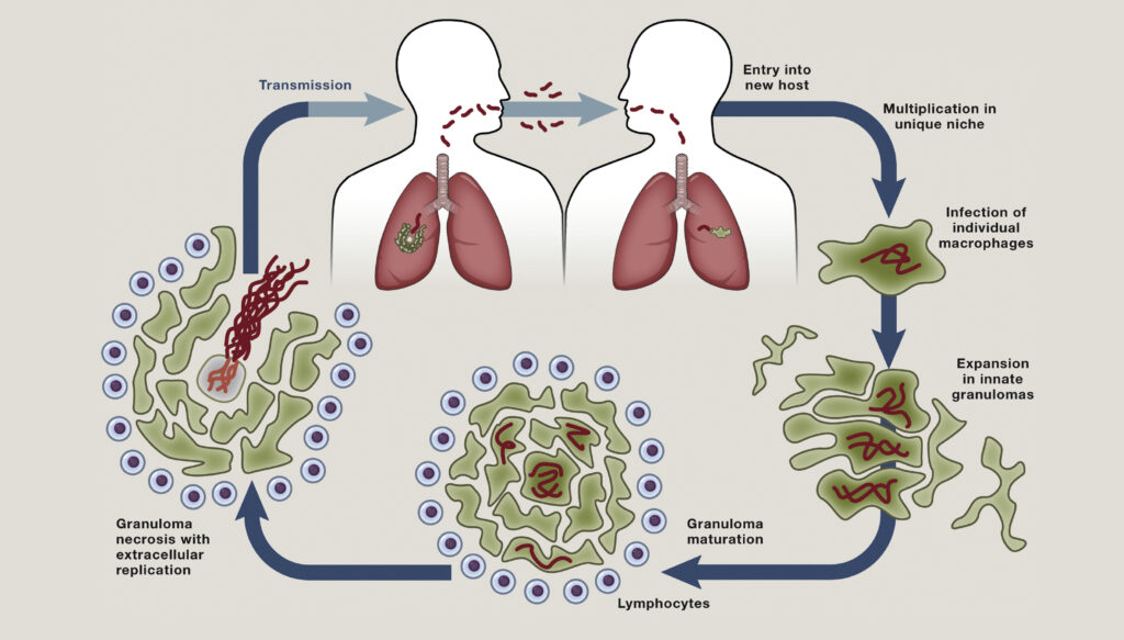 Tuberculosis (TB)