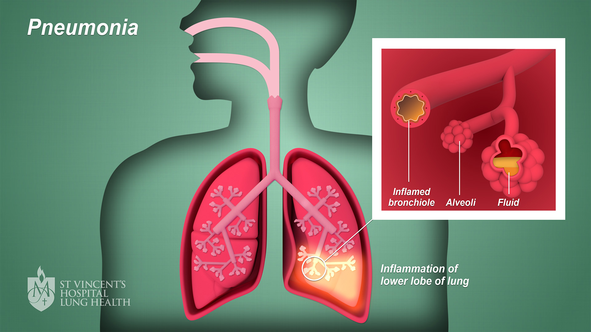 Winter Disease Pneumonia: Symptoms &Treatment