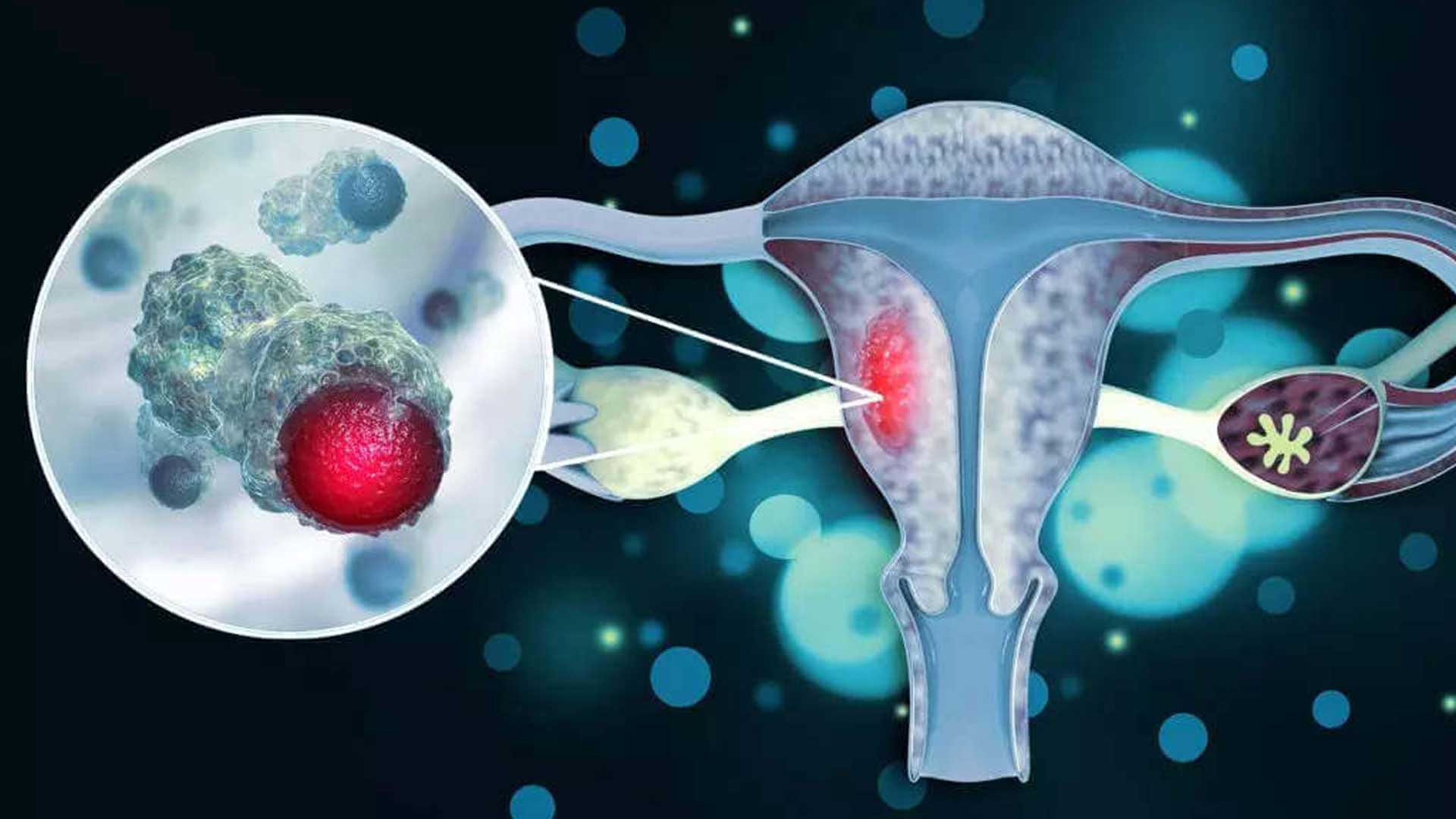Cervical cancer causes, treatment