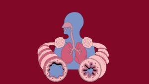 Asthma very common chronic condition