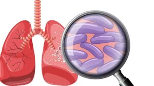Tuberculosis in Bangladesh