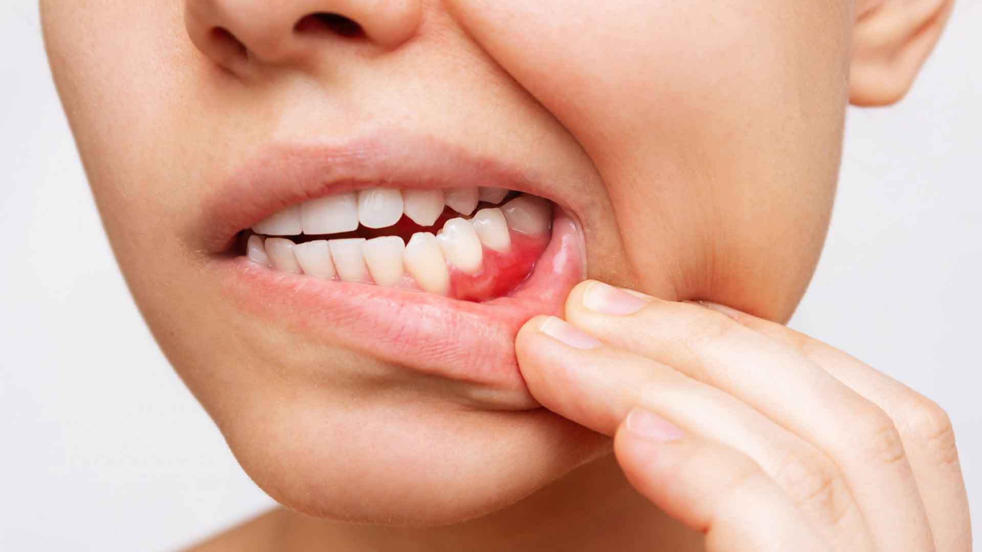 Gum Disease